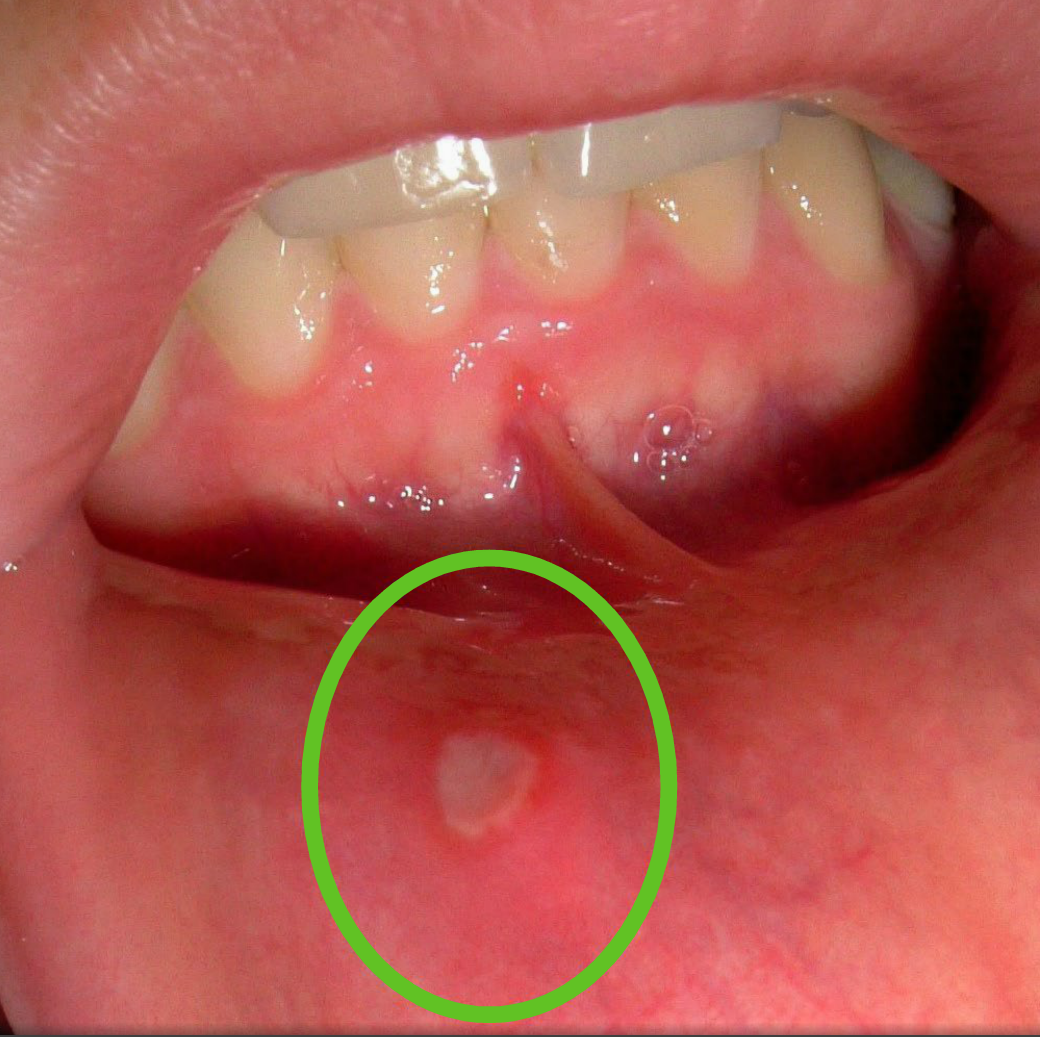 papilloma labbra bocca enterobiasis como se transmite